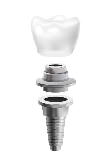 implante_dental